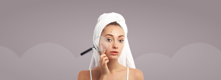 Understanding Acne – Causes, Symptoms And Treatments
