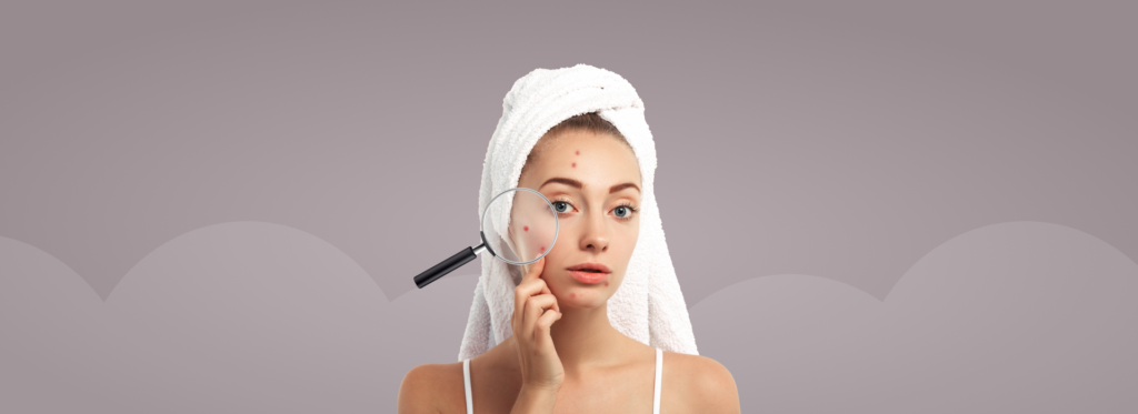 Understanding Acne – Causes, Symptoms And Treatments