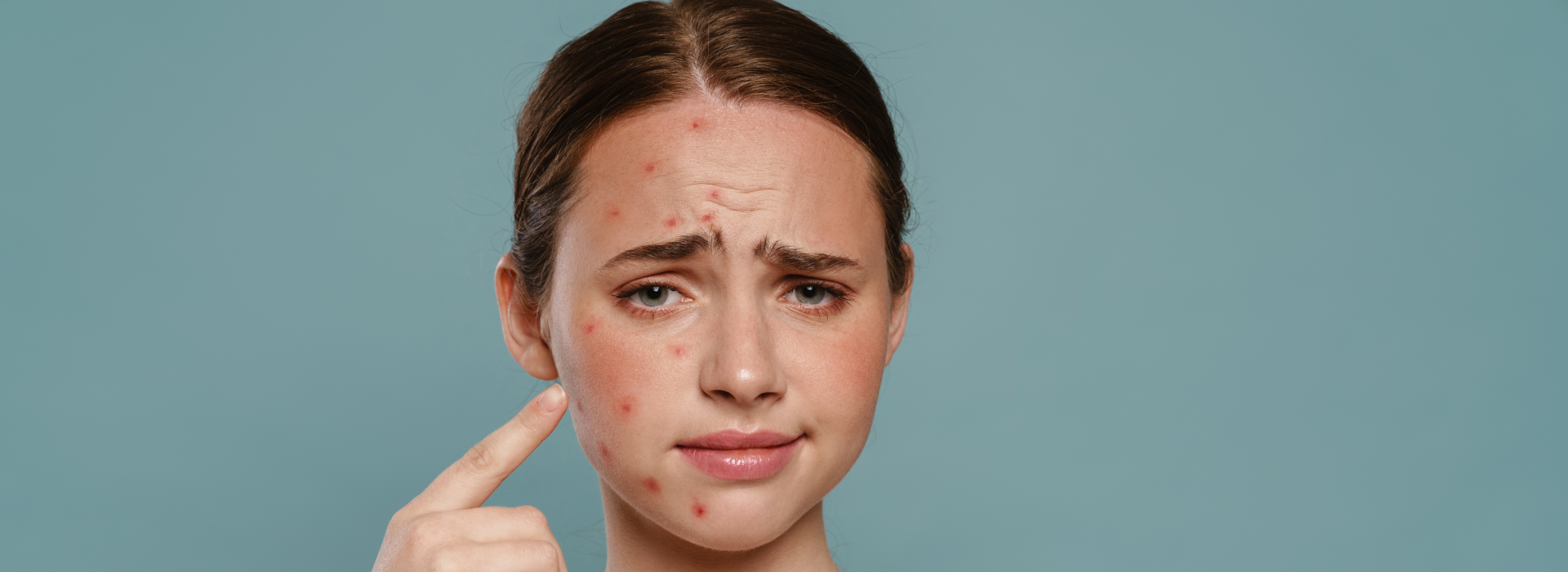 Hormonal acne: What is it and how can you treat it at home? 