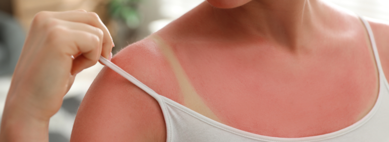 How to heal sunburn: GP-approved tips