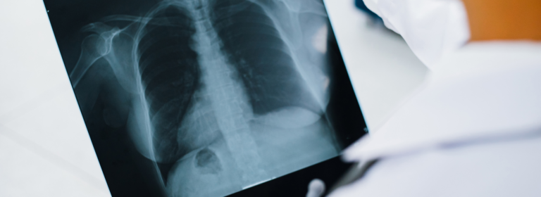 What can a chest X-ray diagnose? Everything you need to know