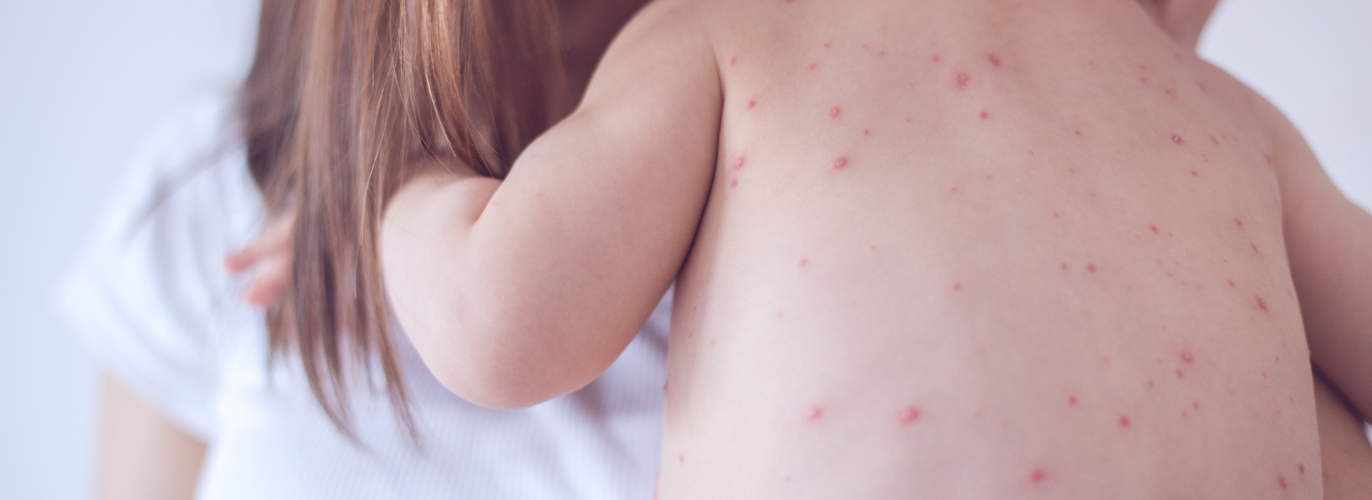 Measles: Symptoms, how it spreads, when to call a GP