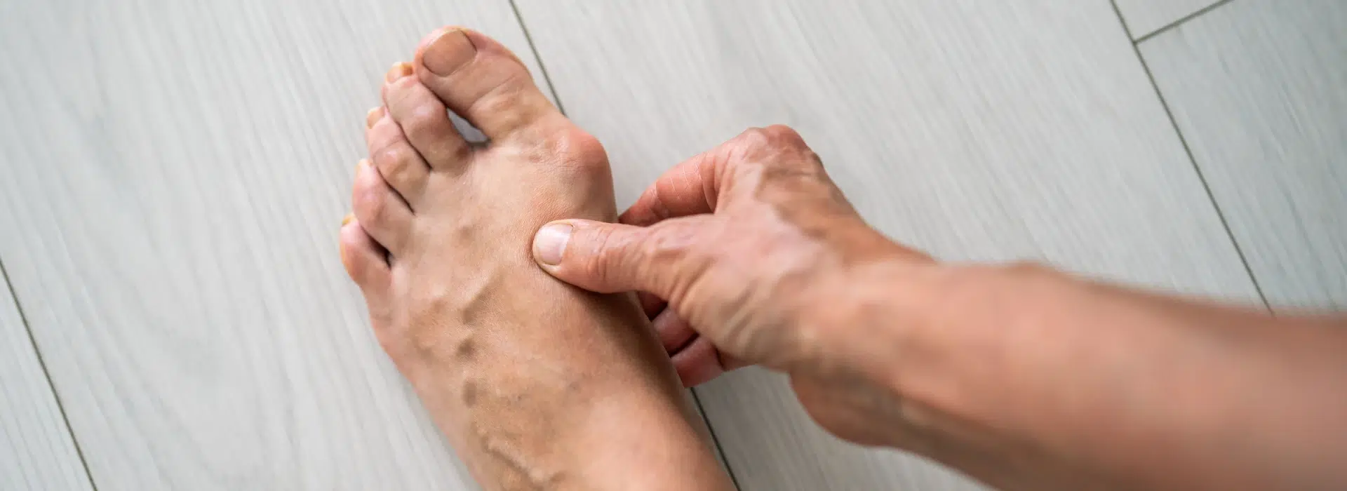 9 foods that cause gout and the best foods to eat